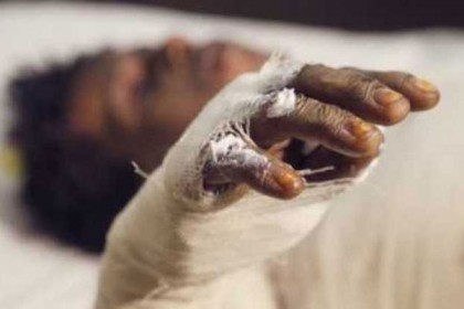 চট্টগ্রামে কারখানার গলিত লোহায় ৩ শ্রমিক দগ্ধ
