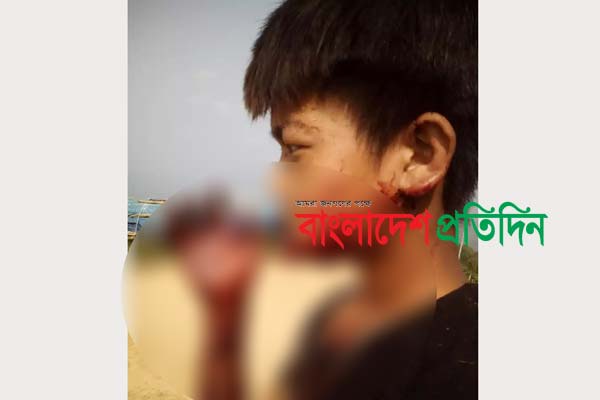 রাঙামাটি ভাল্লুকের আক্রমণে আহত শিশুটি এখন সিএমএইচে