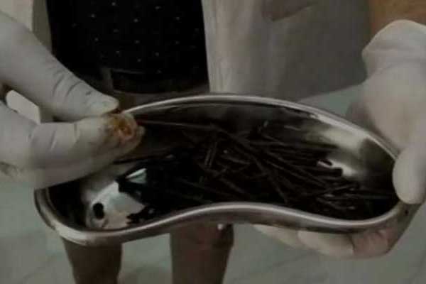 ব্যক্তির পেটে ১১৬ পেরেক, অতঃপর...
