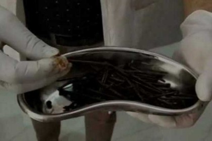 ব্যক্তির পেটে ১১৬ পেরেক, অতঃপর...