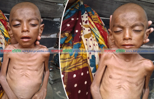 ঝিনাইদহে অজানা রোগে আক্রান্ত শিশু কঙ্কালে পরিণত হচ্ছে