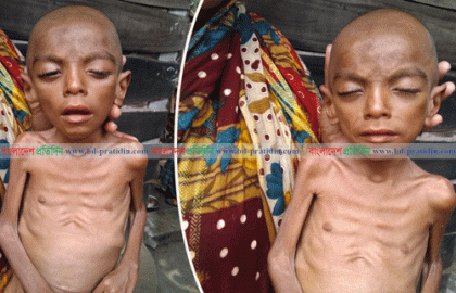 ঝিনাইদহে অজানা রোগে আক্রান্ত শিশু কঙ্কালে পরিণত হচ্ছে
