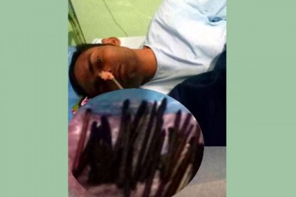 অস্ত্রোপচার করে যুবকের পাকস্থলীতে পাওয়া গেল ৩৩টি কলম!