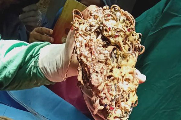 তরুণীর পেটে দুই কেজি সোনার গয়না!