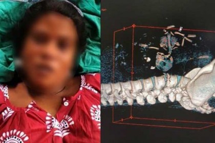 জরায়ু নয়, মায়ের পাকস্থলী-লিভারের ফাঁকে বড় হচ্ছিল শিশুটি!