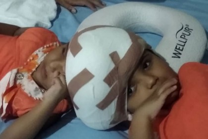 জমজ মাথার শিশু রাবেয়া ও রোকেয়ার অস্ত্রোপচারে সাফল্য