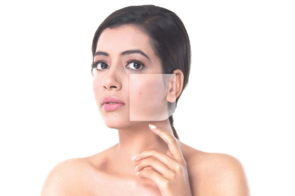 চিকেন পক্স সারাতে