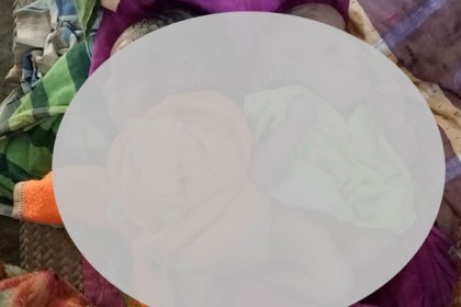 বড়াইগ্রামে জোড়া লাগা জমজ শিশুর জন্ম 
