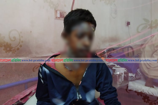 আগুন নিয়ে খেলতে গিয়ে ঝলসে গেল শিশুর মুখ!