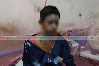 আগুন নিয়ে খেলতে গিয়ে ঝলসে গেল শিশুর মুখ!