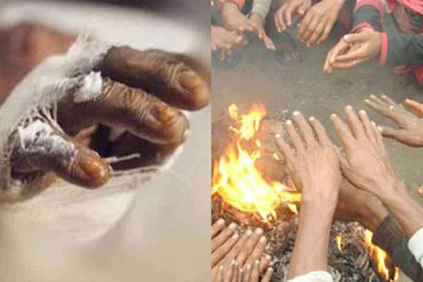 রমেক হাসপাতালে আরও এক অগ্নিদগ্ধের মৃত্যু