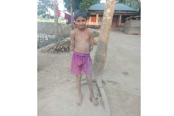 টাইফয়েডে মানসিক ভারসাম্য হারানো শিশুর শিকলে বাঁধা জীবন