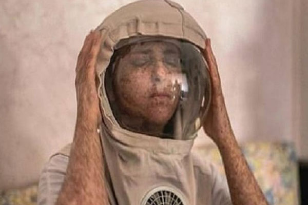 যে কারণে ২০ বছর ধরে হেলমেট পরে আছেন এই নারী