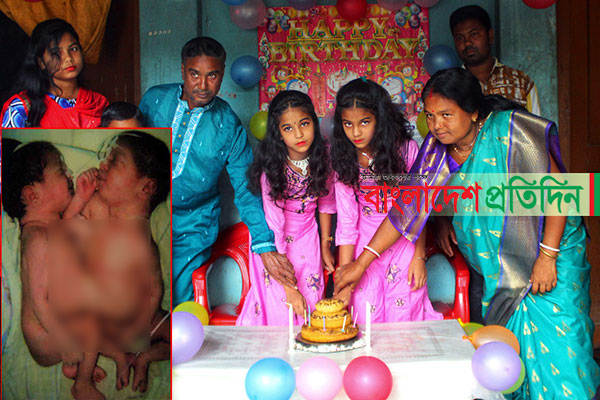 কেমন আছেন জোড়া লাগানো অবস্থায় জন্ম নেওয়া সেই দুই বোন!