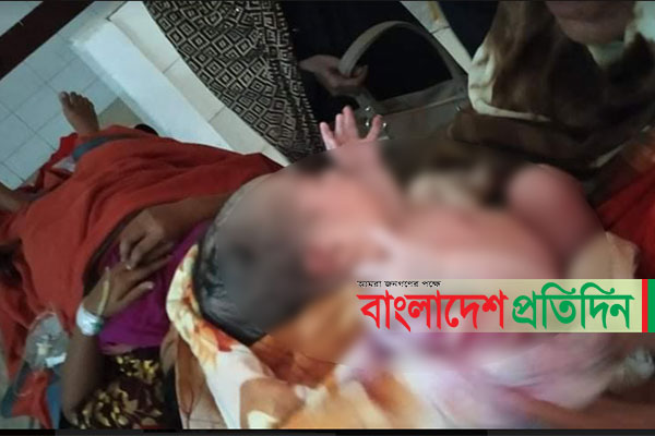 সিজারের সময় অসতর্কতায় নবজাতকের পেট কর্তন, অতঃপর...