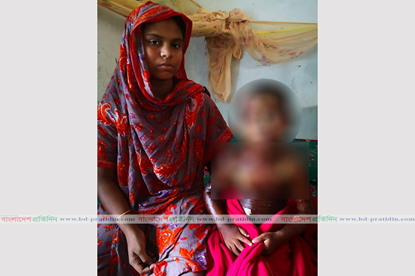 ঝলসে যাওয়া শিশু আব্দুল্লাহর দায়িত্ব নিলেন প্রতিমন্ত্রী পলক
