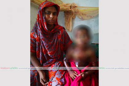 ঝলসে যাওয়া শিশু আব্দুল্লাহর দায়িত্ব নিলেন প্রতিমন্ত্রী পলক