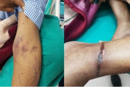 আইসিইউ‌তে রোগীর হাত-পা বেঁধে চিকিৎসা! 

