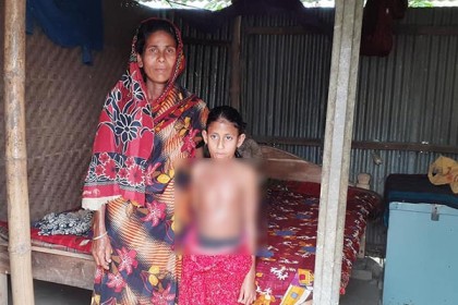 চিকিৎসা খরচ চায় অগ্নিদগ্ধ এতিম প্রতিবন্ধী আইভি 