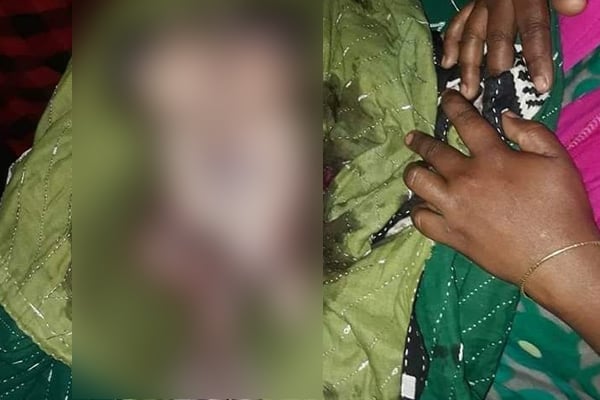 পাথরঘাটায় বুক-পেট জোড়া লাগানো মৃত ২ শিশুর জন্ম