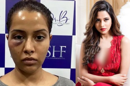 সুন্দর হতে চর্মরোগ বিশেষজ্ঞের কাছে গিয়ে এ কী হাল অভিনেত্রীর!