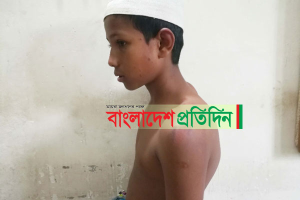 শিশু শিক্ষার্থীকে বেত্রাঘাতে জখম করলেন মাদ্রাসার সভাপতি ও শিক্ষক

