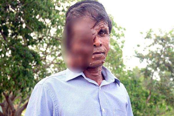 বিরল রোগে আক্রান্ত দিনমজুর, অর্থাভাবে হচ্ছেনা চিকিৎসা 