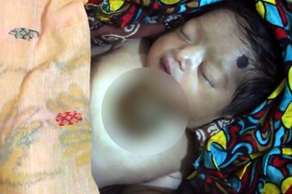 বক্ষদেশের বাইরে হৃদপিণ্ড নিয়ে জন্মানো শিশুটি মারা গেছে