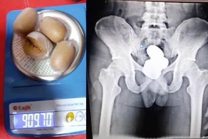 পায়ুপথে লুকিয়ে ১ কেজি স্বর্ণ পাচারের চেষ্টা

