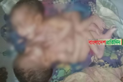 ৮ দিন পর মারা গেল জোড়া লাগা সেই যমজ শিশু