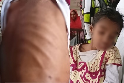 দেড় বছর ধরে গৃহকর্ত্রীর নির্মম নির্যাতনের শিকার শিশু আকলিমা