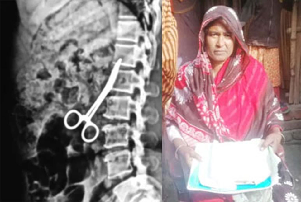 পেটে কাঁচি রেখে সেলাই, ২০ বছর ধরে বয়ে বেড়াচ্ছেন গৃহবধূ