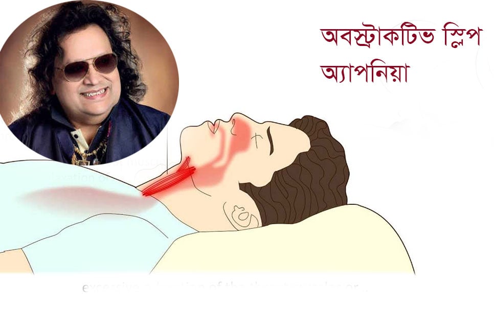 বাপ্পি লাহিড়ির মৃত্যু: অবসট্রাক্টিভ স্লিপ অ্যাপনিয়া কী? জেনে নিন লক্ষণসমূহ