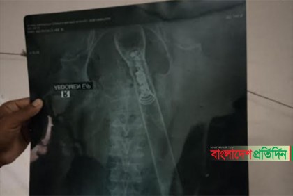 বৃদ্ধের পায়ু পথে টর্চলাইট ঢুকিয়ে নির্যাতনের অভিযোগ 