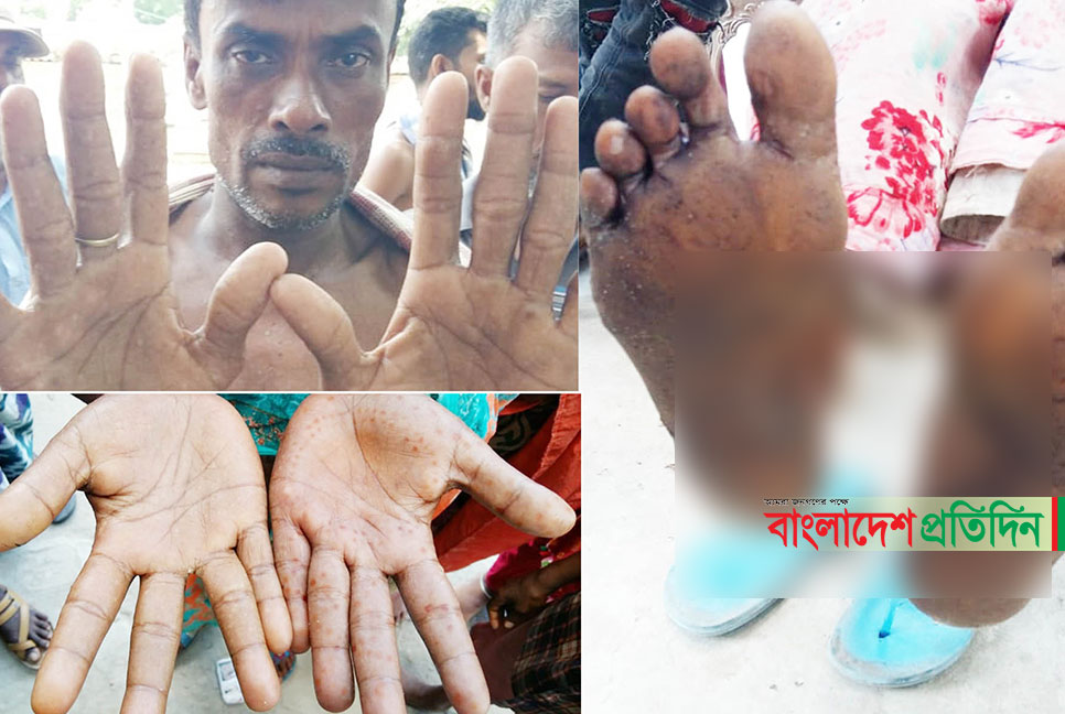 চাঁপাইনবাবগঞ্জের বেতবাড়িয়া গ্রামের অধিকাংশ আর্সেনিকে আক্রান্ত