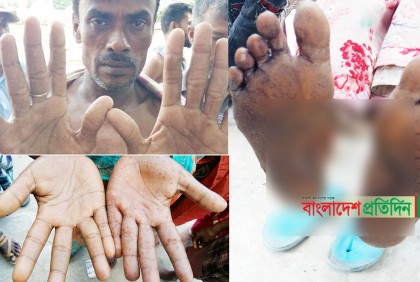 চাঁপাইনবাবগঞ্জের বেতবাড়িয়া গ্রামের অধিকাংশ আর্সেনিকে আক্রান্ত