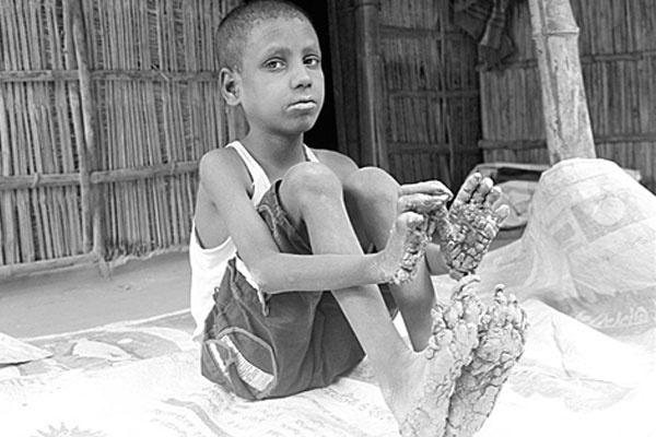 হঠাৎ পুরো শরীর কালো হয়ে গেল ‘বৃক্ষমানবের’