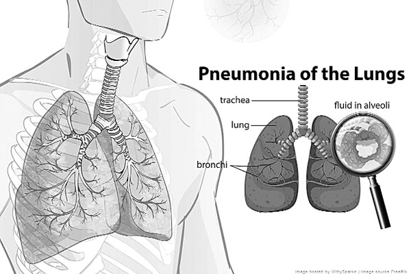 নিউমোনিয়ার লক্ষণ ও প্রতিরোধে করণীয়