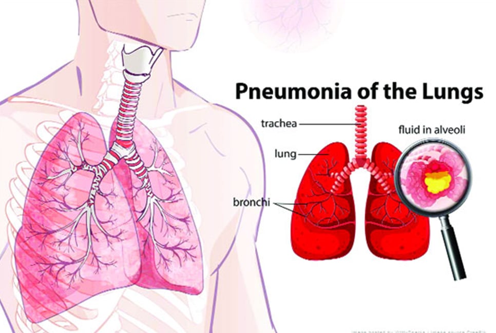 নিউমোনিয়ার লক্ষণ ও প্রতিরোধে করণীয়
