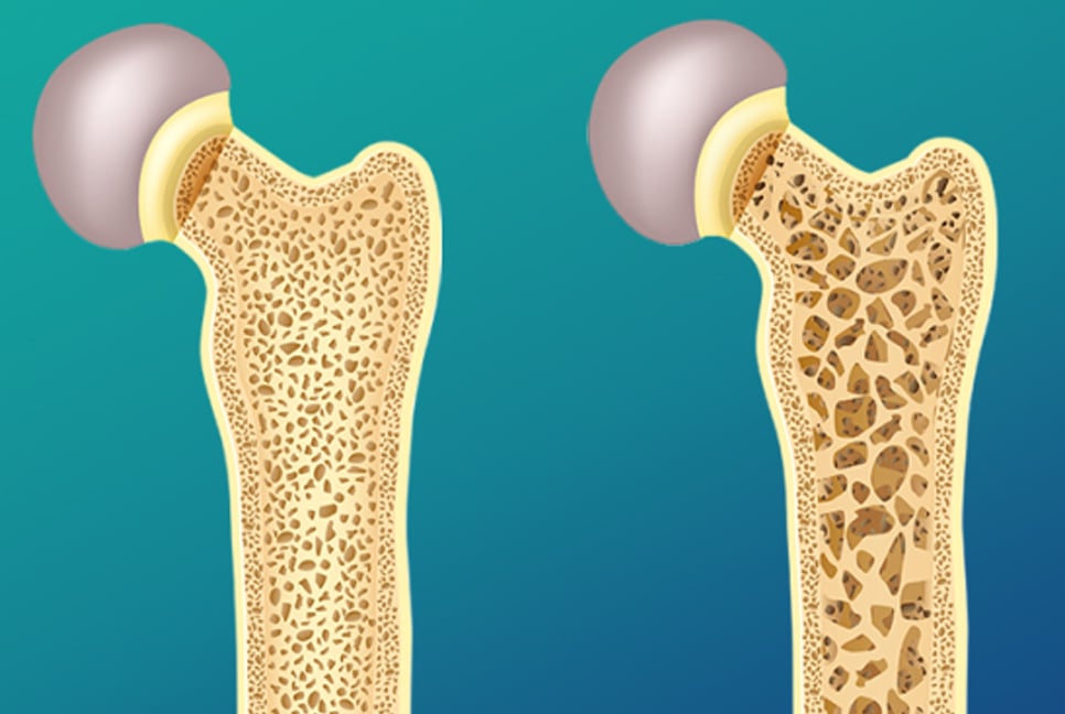 অস্টিওপরোসিস বা হাড়ের ভঙ্গুরতা রোগ 