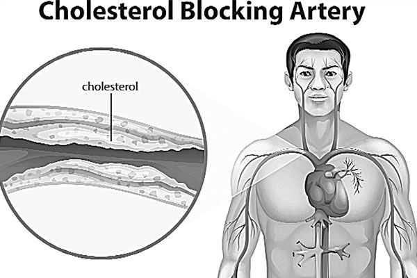কোলেস্টেরল ও হৃদরোগ