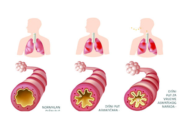 হাঁপানি ও হৃদরোগের সম্পর্ক