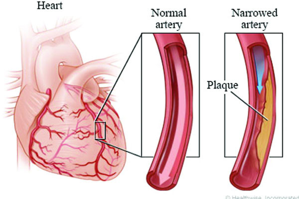 হার্টে ব্লক ছাড়াও এনজিনা!