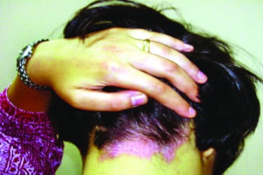 সোরিয়াসিস ও একজিমা