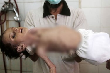 গাজায় খাবারের অভাবে তিন মাসের শিশুর মৃত্যু