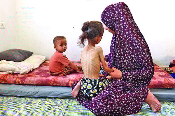 তীব্র অপুষ্টিতে ভোগা ফিলিস্তিনি শিশু