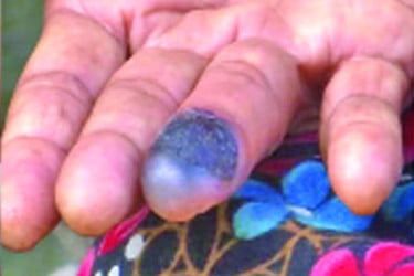 রংপুরে আতঙ্ক ছড়াচ্ছে অ্যানথ্রাক্স