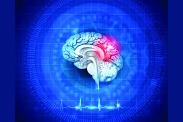 স্ট্রোকের চিকিৎসা ঢাকাকেন্দ্রিক