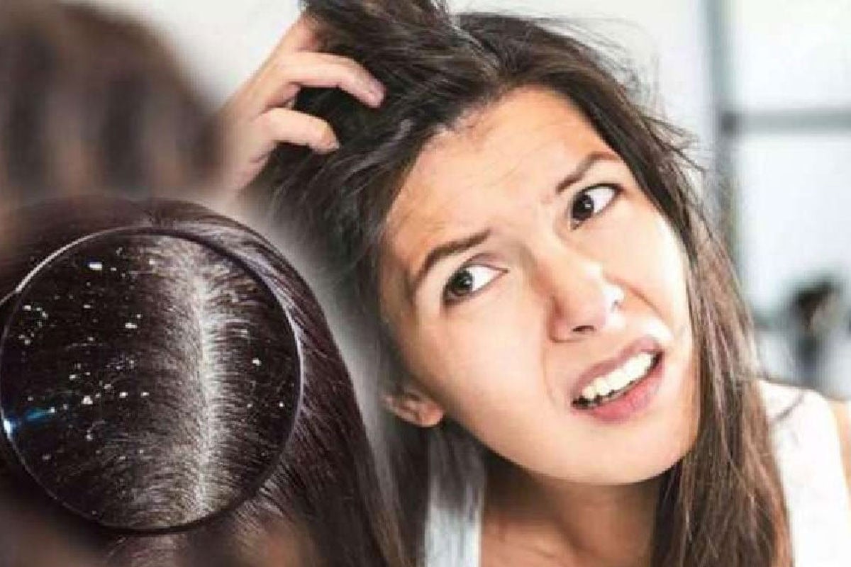 শীত এলেই চুলকাতে থাকে মাথার ত্বক, যেভাবে নেবেন চুলের যত্ন