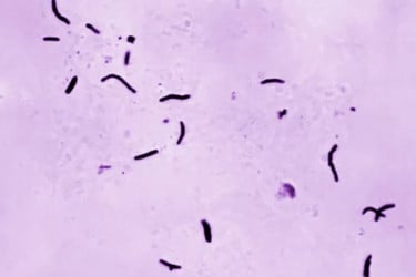 ২০২৪ সালে যক্ষ্মায় মারা গেছে ১২ লাখ ৩০ হাজার মানুষ: বিশ্ব স্বাস্থ্য সংস্থা